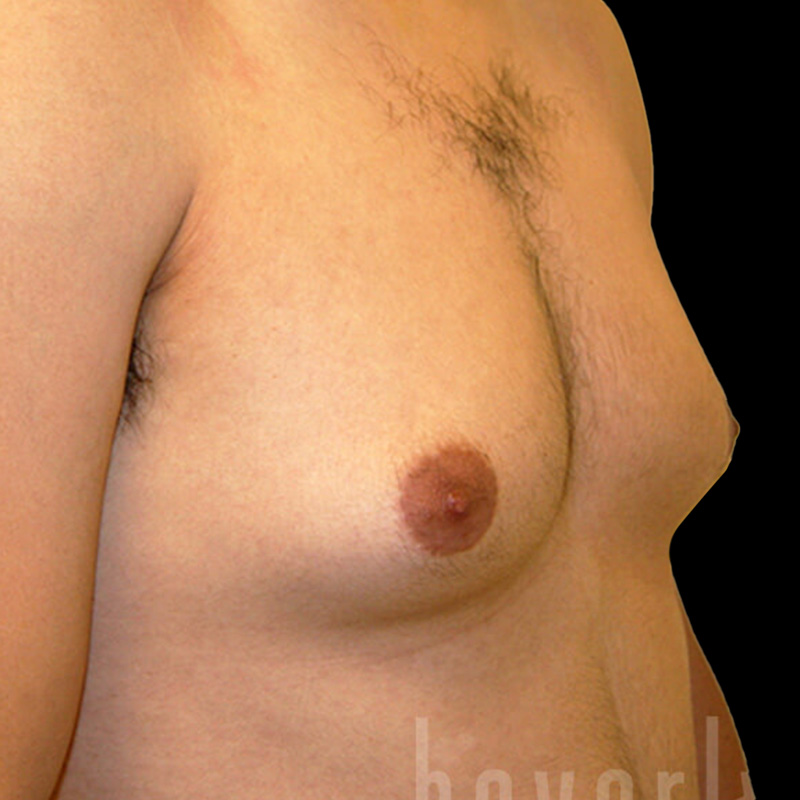 Case--9487 | Before Gynecomastia 2
