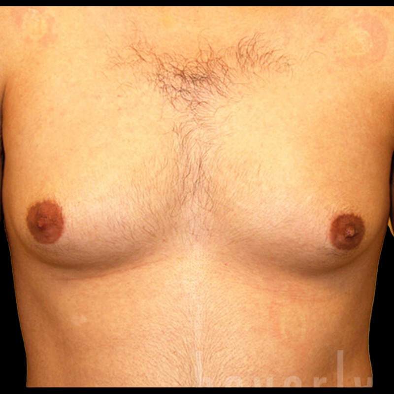Case--9487 | Before Gynecomastia