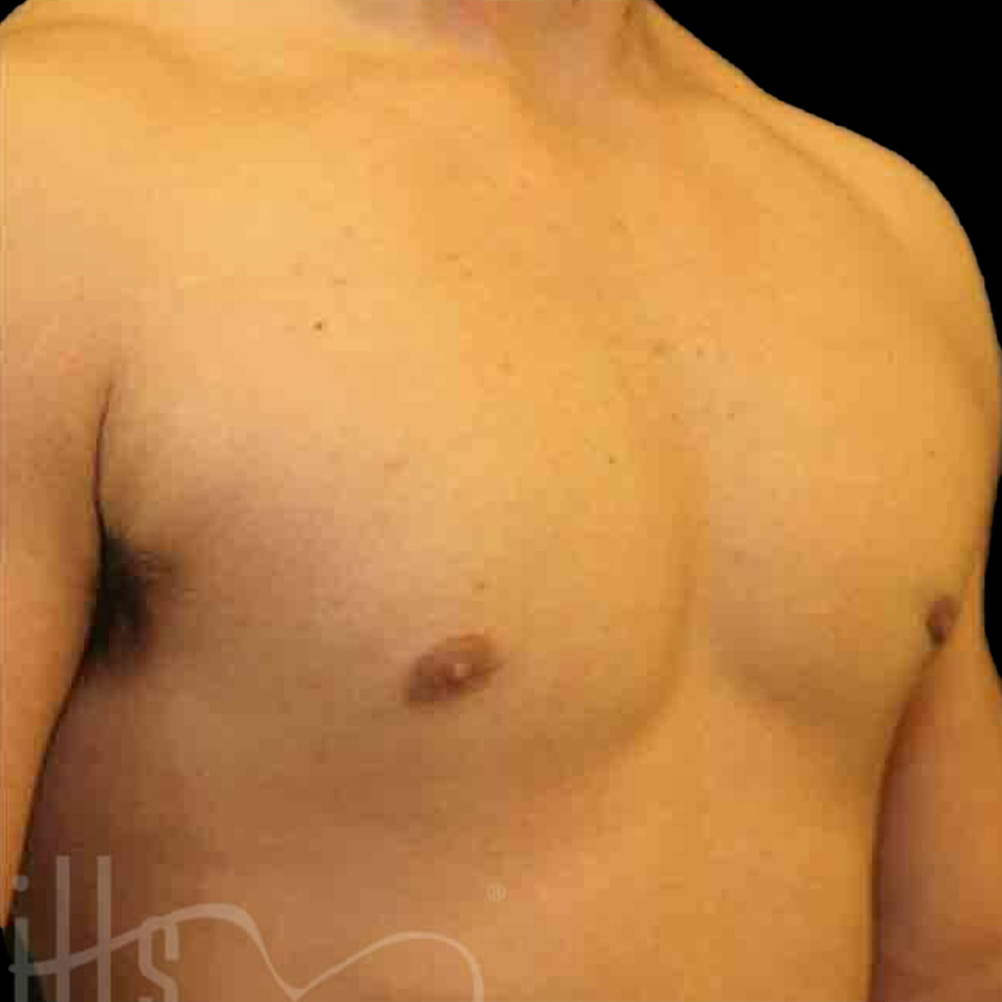 Case--5454 | After Gynecomastia 2