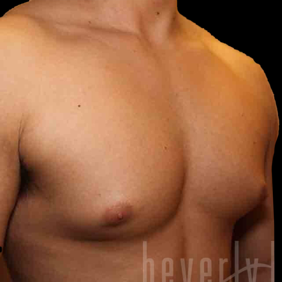 Case--5454 | Before Gynecomastia 2