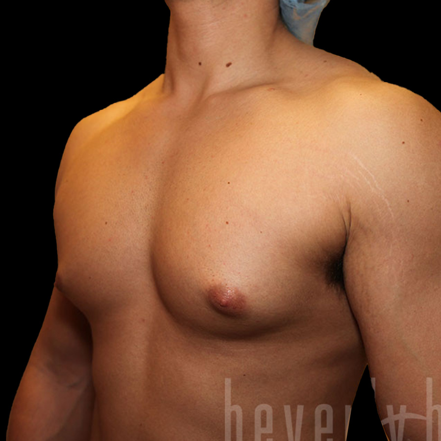 Case--5454 | Before Gynecomastia 3