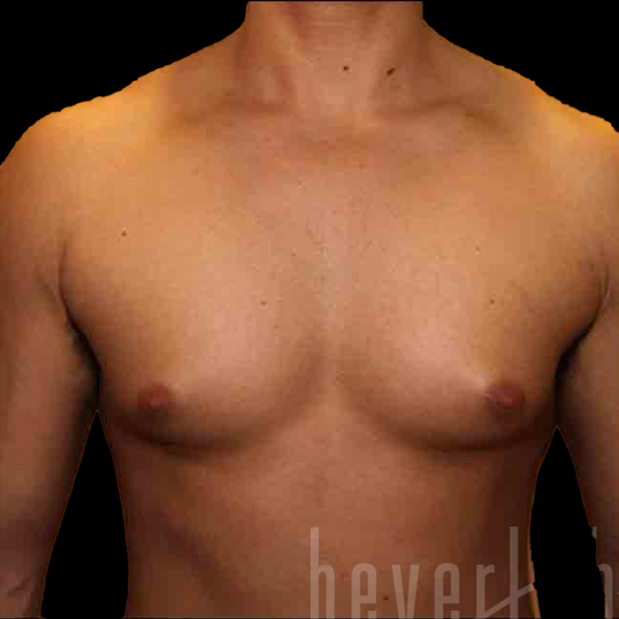 Case--5454 | Before Gynecomastia