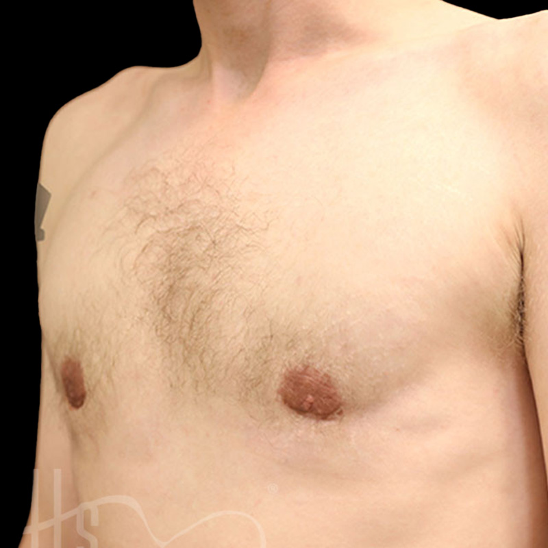 Case--7269 | After Gynecomastia