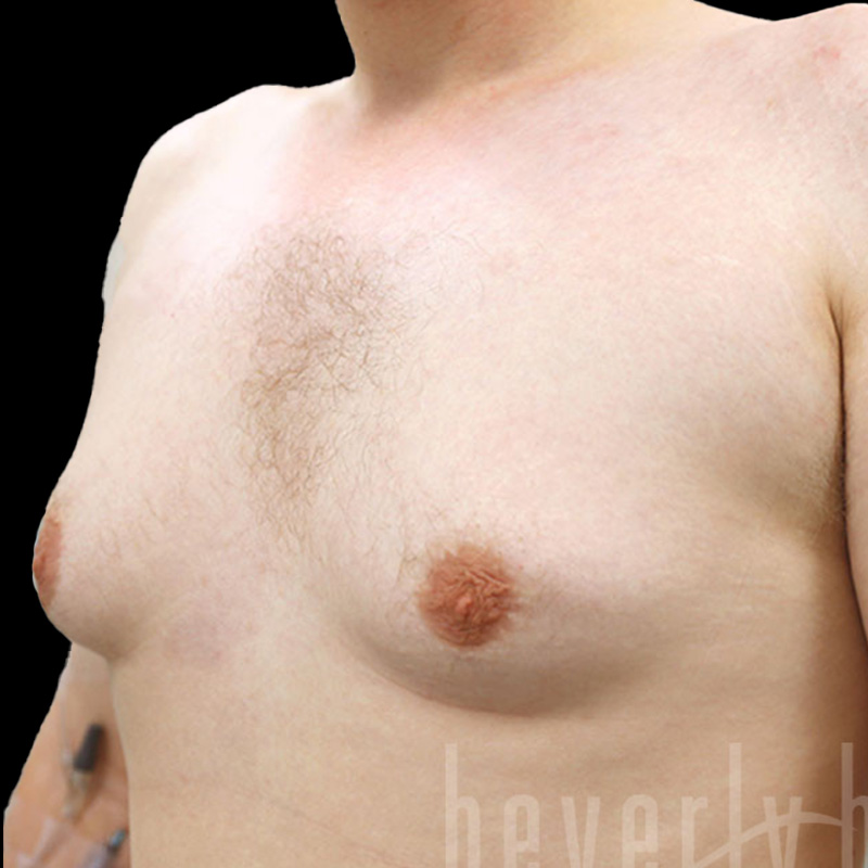 Case--7269 | Before Gynecomastia
