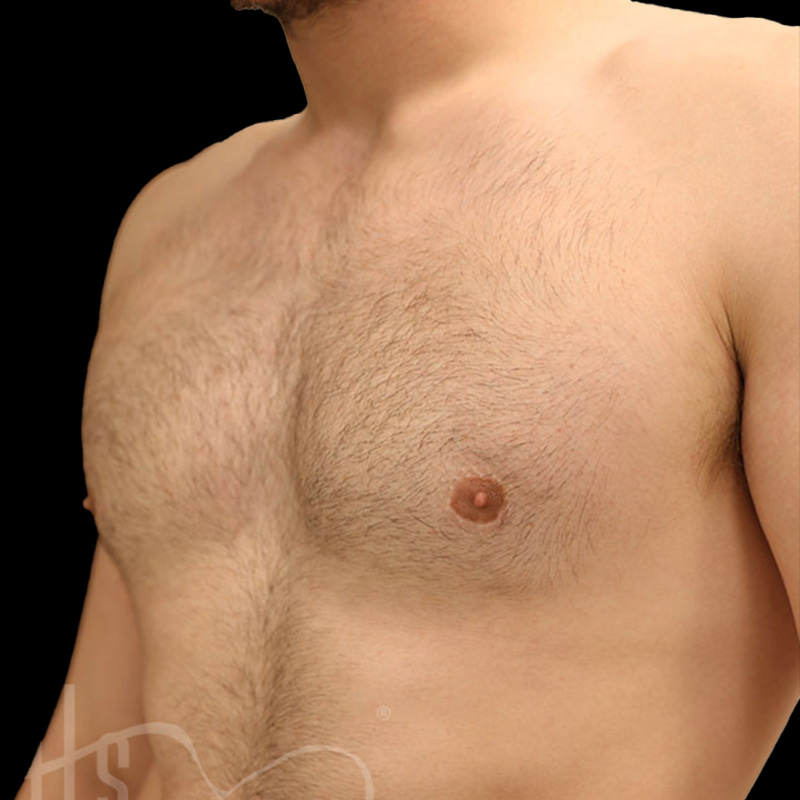 Case--2288 | After Gynecomastia 2