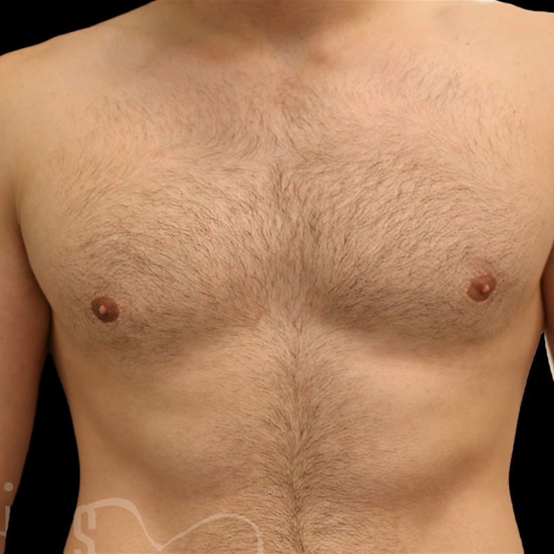 Case--2288 | After Gynecomastia