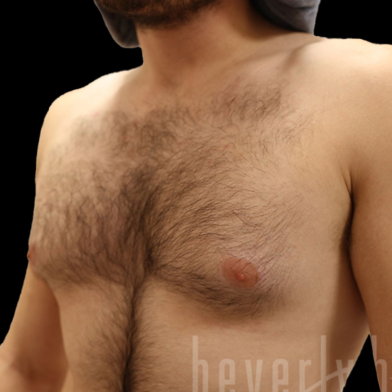 Case--2288 | Before Gynecomastia 2