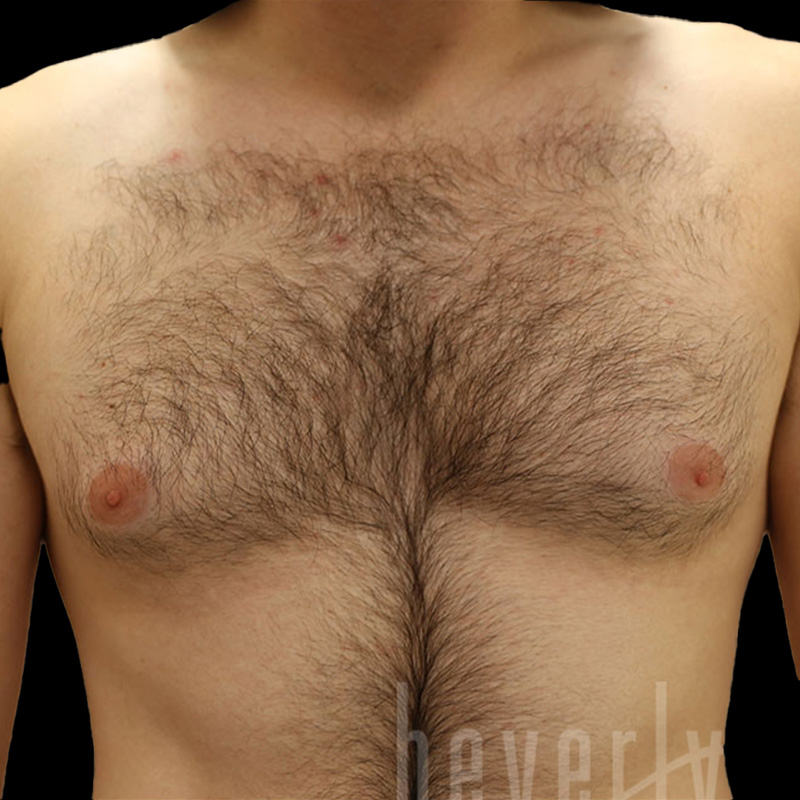 Case--2288 | Before Gynecomastia