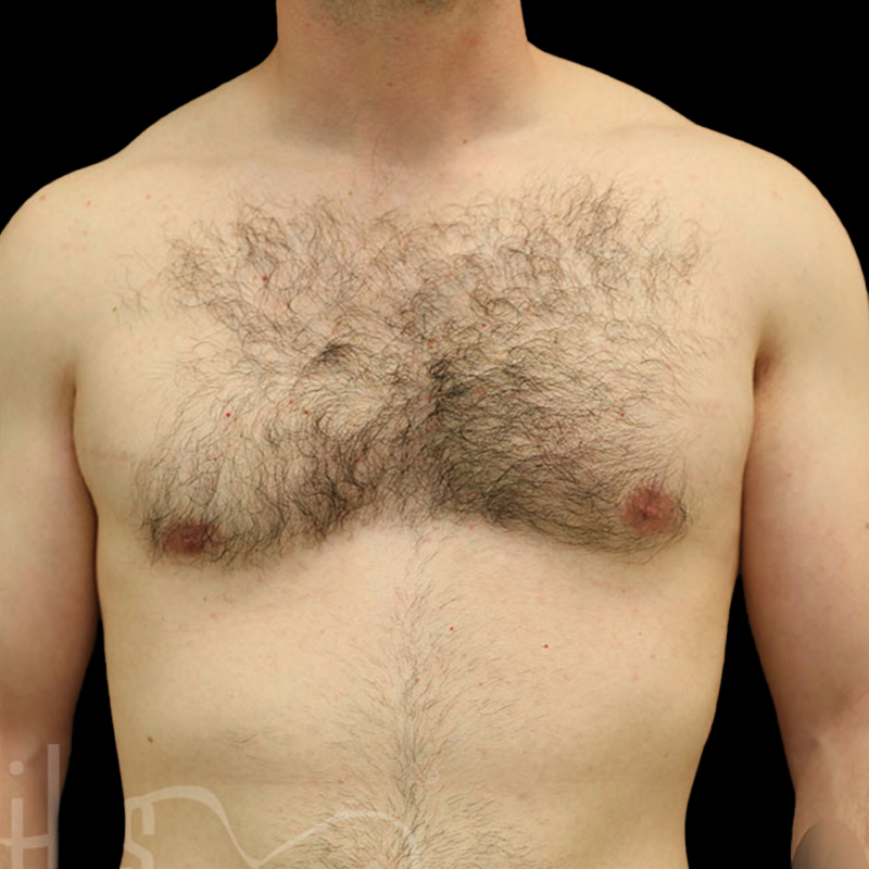 Case--6492 | After Gynecomastia