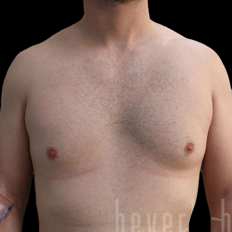 Case--6492 | Before Gynecomastia
