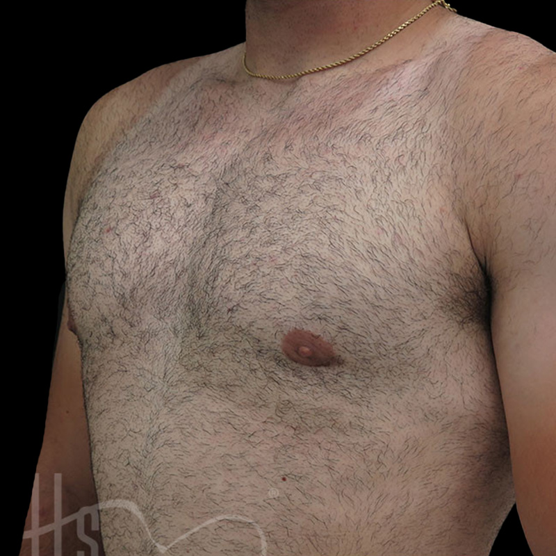 Case--9279 | After Gynecomastia
