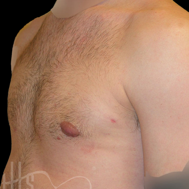 Case--4007 | After Gynecomastia 2
