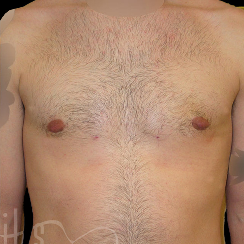 Case--4007 | After Gynecomastia