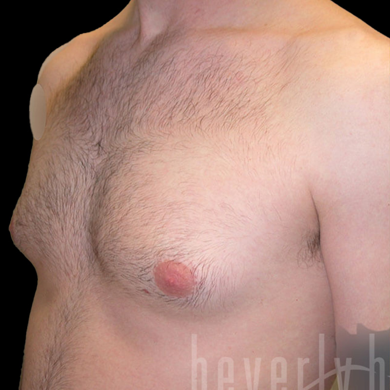 Case--4007 | Before Gynecomastia 2