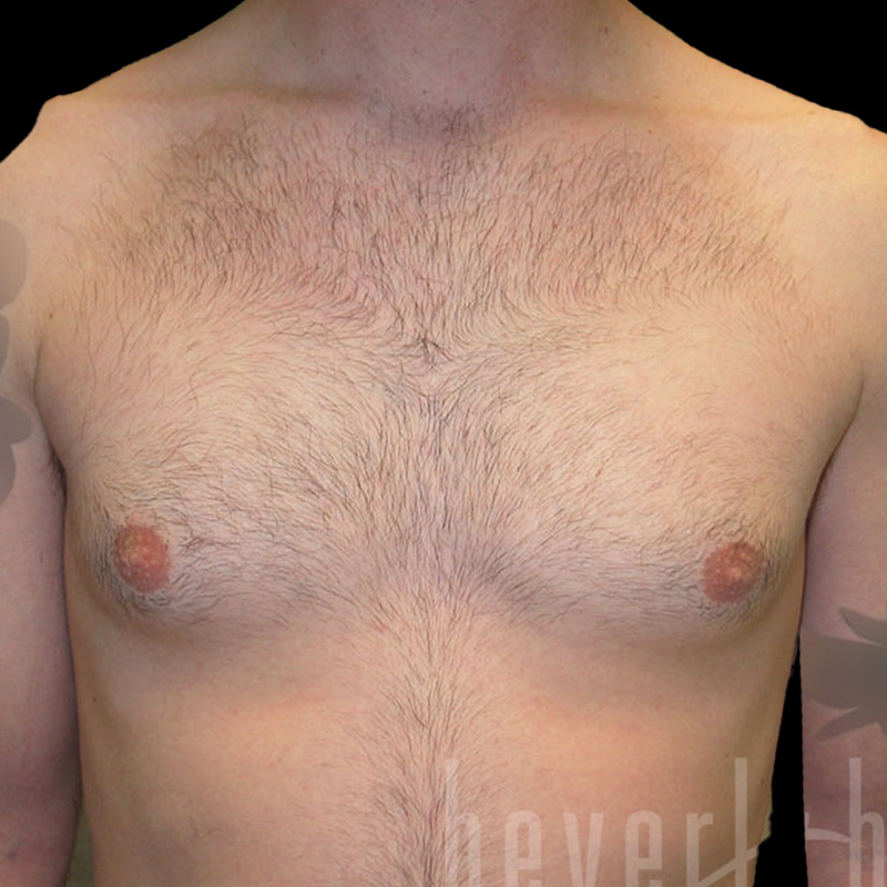 Case--4007 | Before Gynecomastia