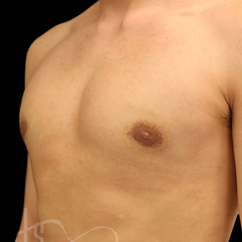 Case--3305 | After Gynecomastia 2