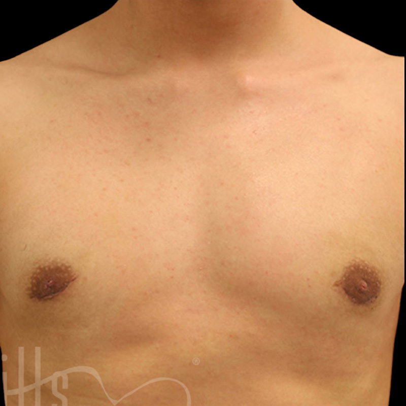 Case--3305 | After Gynecomastia