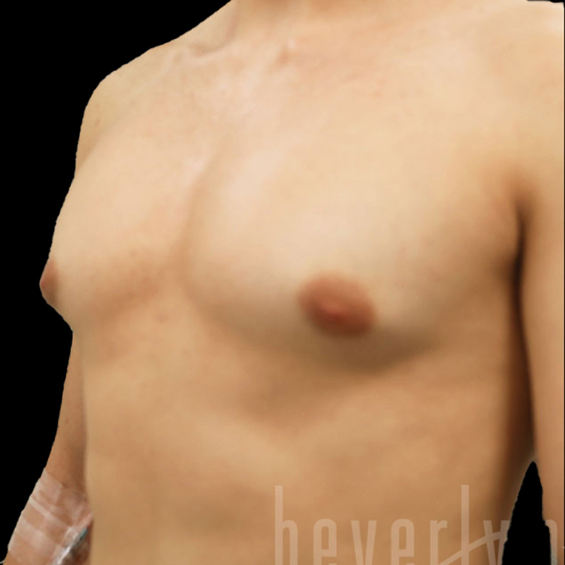 Case--3305 | Before Gynecomastia 2