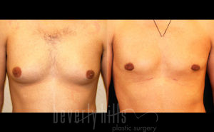 Gynecomastia Patient 19 Before & After - Thumbnail