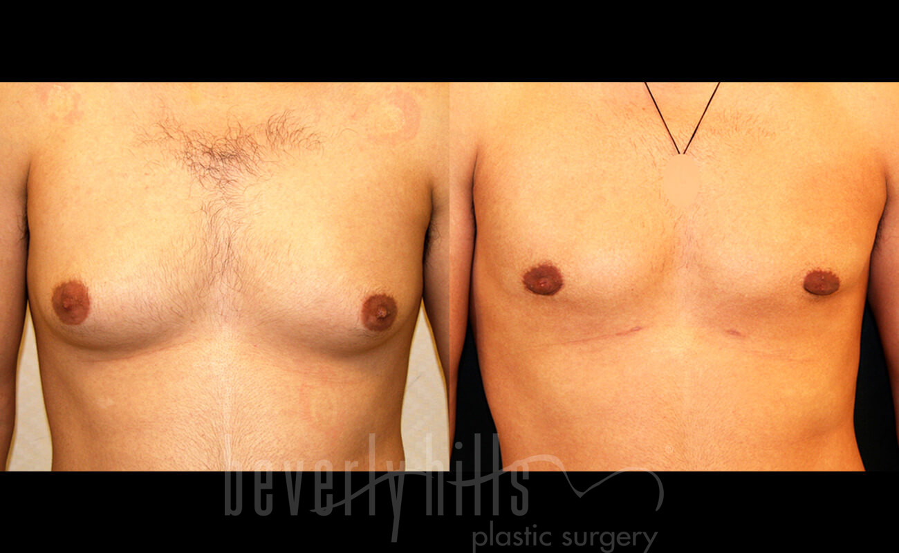 Gynecomastia Patient 19 Before & After