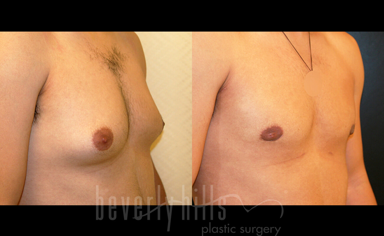 Gynecomastia Patient 19 Before & After