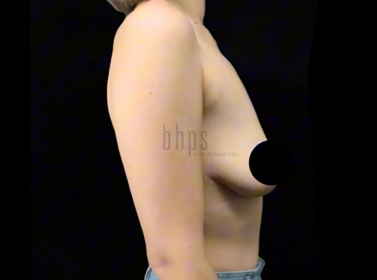 Case--8249 | Before Breast Augmentation with Lift 3