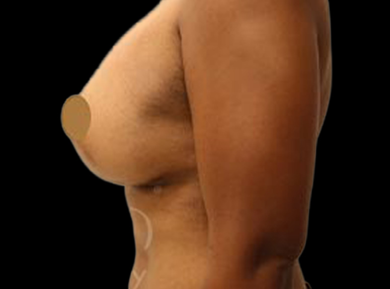 Case--2374 | After Breast Augmentation with Lift