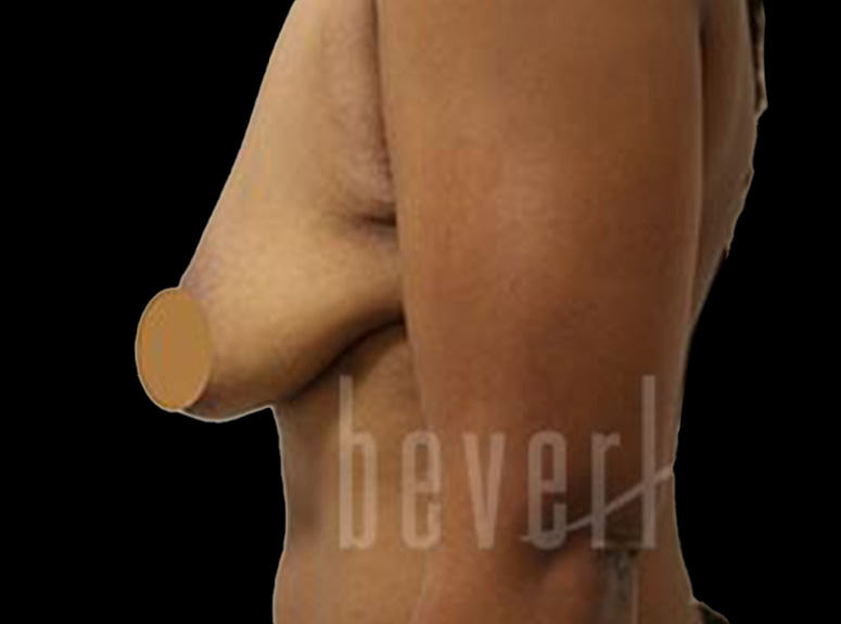 Case--2374 | Before Breast Augmentation with Lift