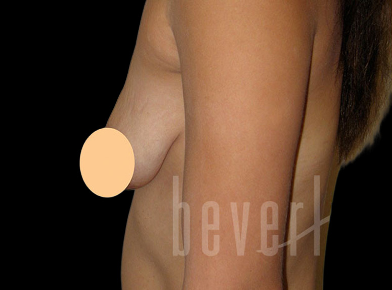 Case--1539 | Before Breast Augmentation with Lift