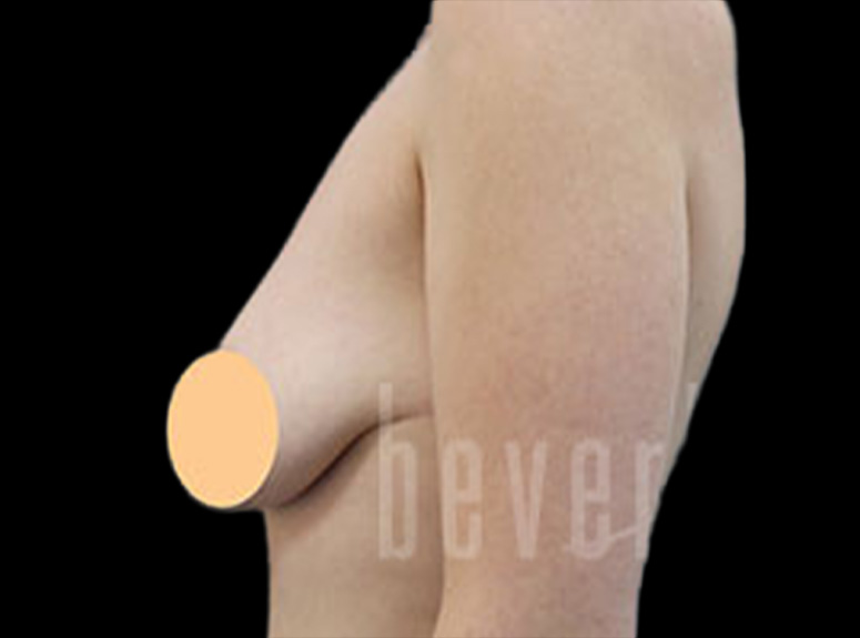 Case--4810 | Before Breast Augmentation with Lift