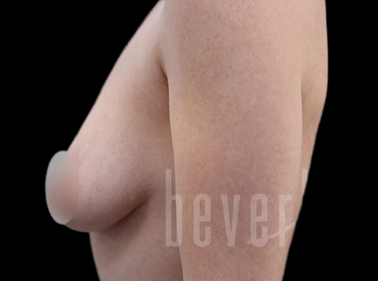 Case--7296 | Before Breast Augmentation with Lift