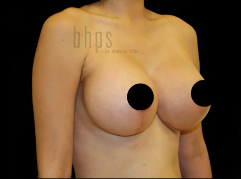Case--3738 | After Breast Augmentation with Lift 2