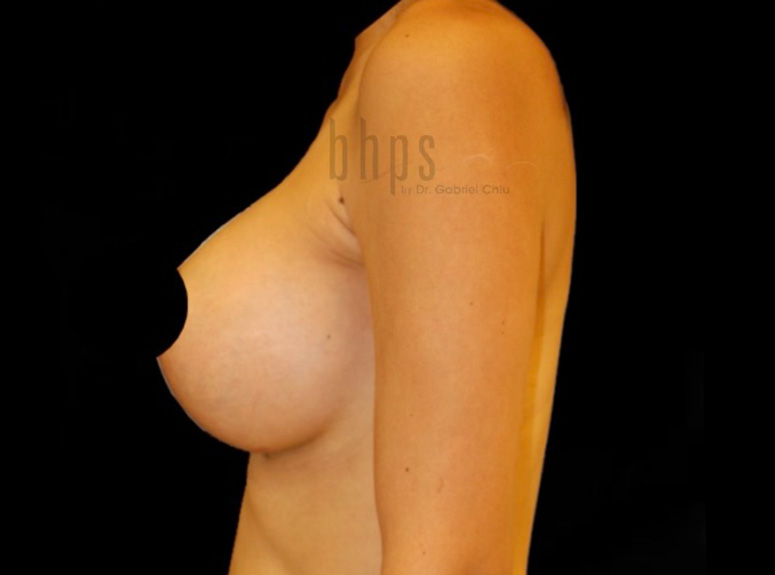 Case--3738 | After Breast Augmentation with Lift 3