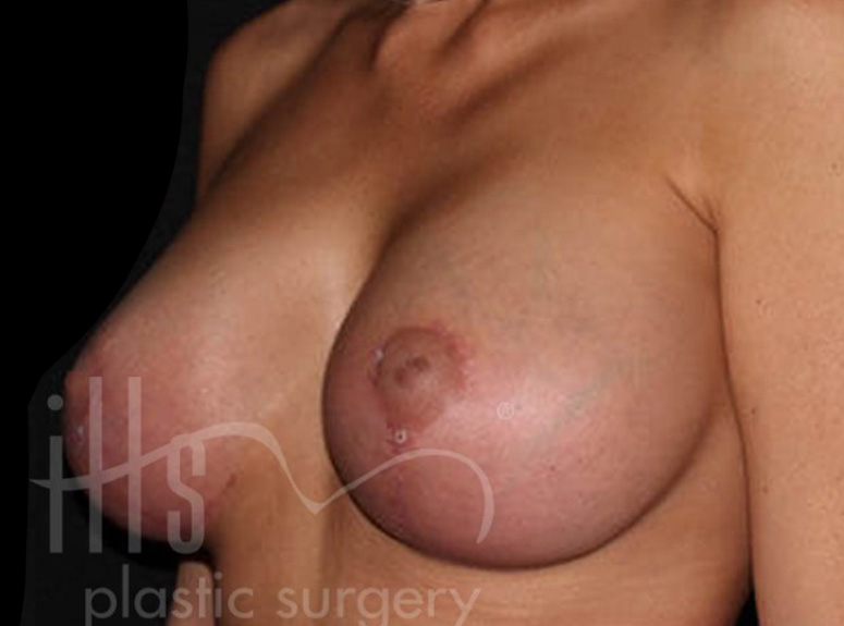 Case--7769 | After Breast Augmentation with Lift 4