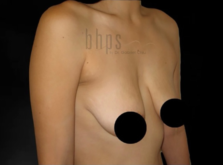 Case--3738 | Before Breast Augmentation with Lift 2