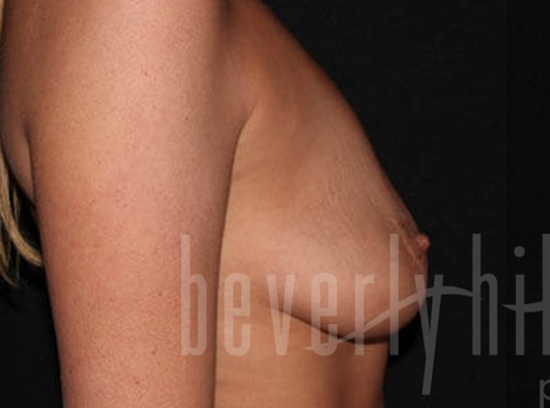 Case--7769 | Before Breast Augmentation with Lift 3