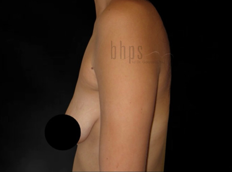 Case--3738 | Before Breast Augmentation with Lift 3