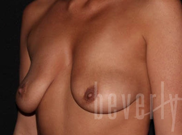Case--7769 | Before Breast Augmentation with Lift 4