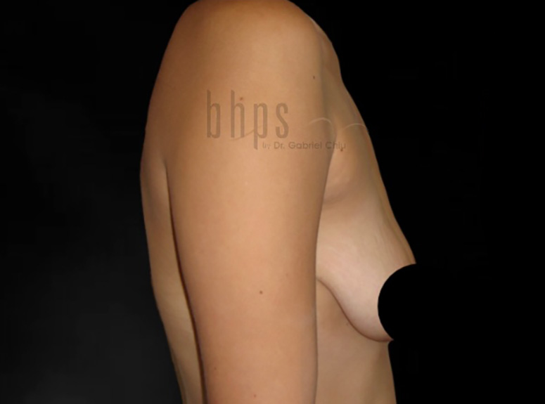 Case--3738 | Before Breast Augmentation with Lift 4