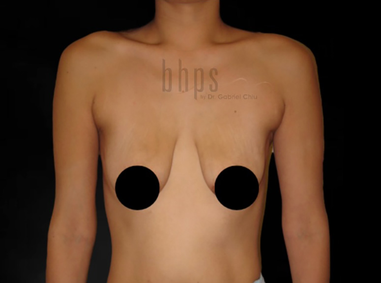 Breast Lift Mastoplexy Patient Before - 2
