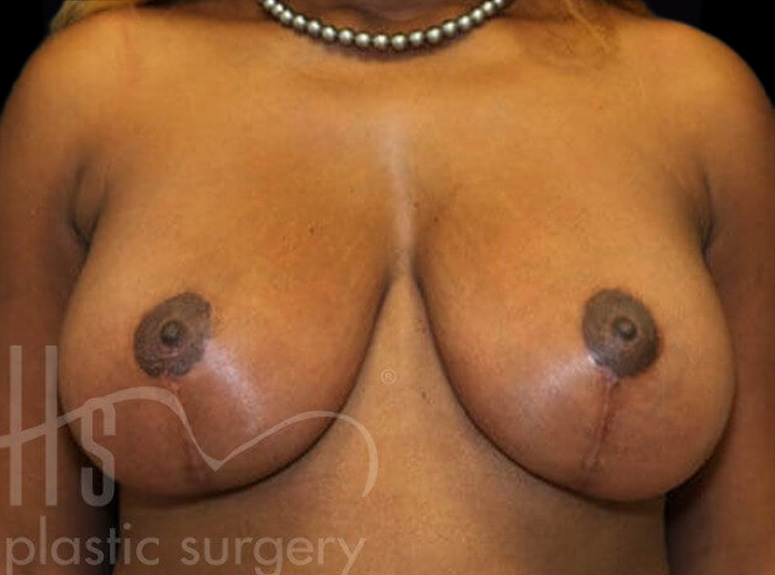 Case--9345 | After Breast Augmentation with Lift