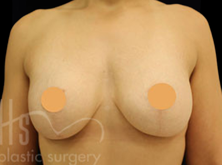 Case--7176 | After Breast Augmentation with Lift