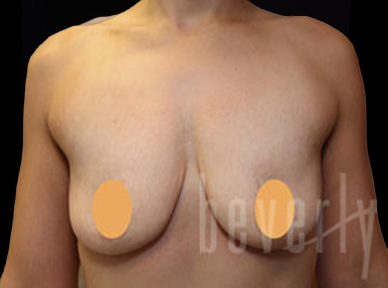 Case--7176 | Before Breast Augmentation with Lift