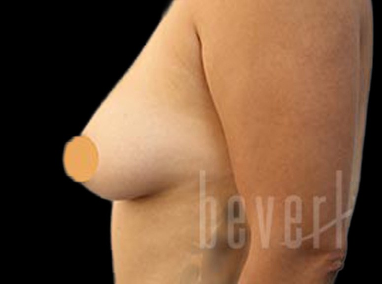 Case--5842 | Before Breast Augmentation with Lift