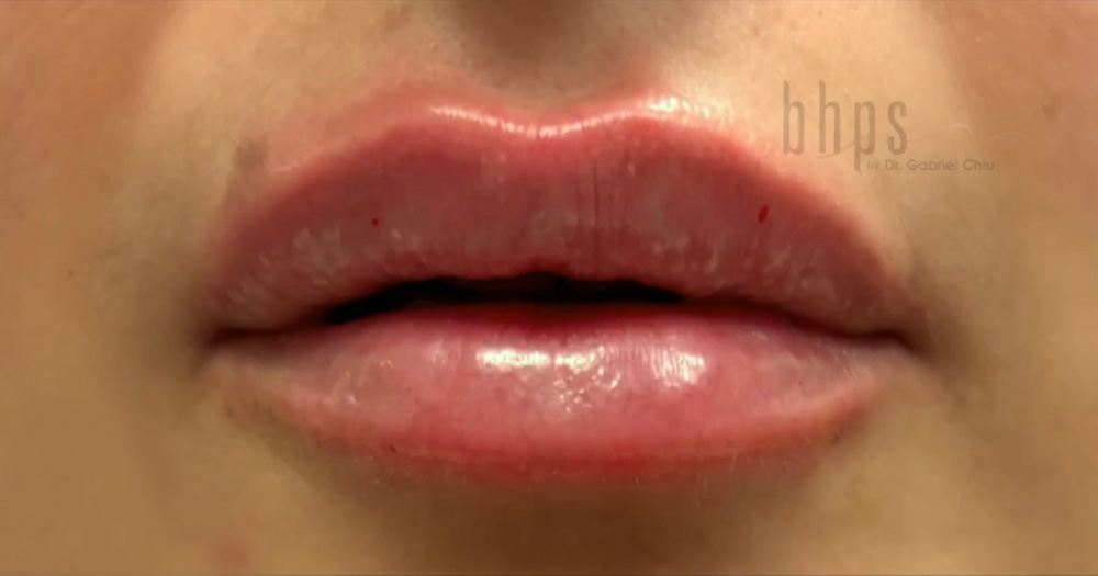 Case--8820 | After Lip Filler