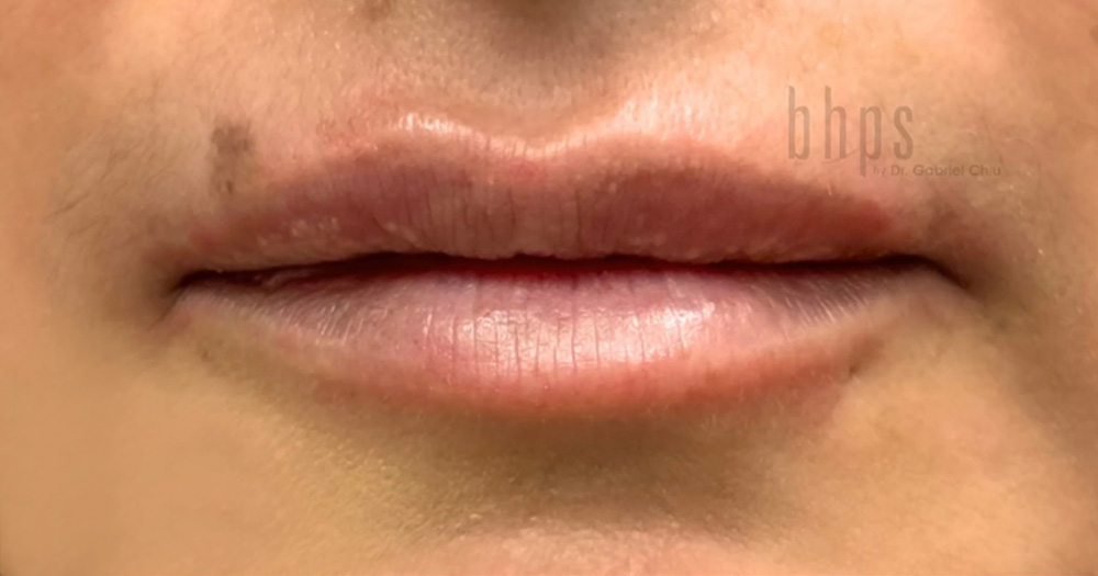 Case--8820 | Before Lip Filler