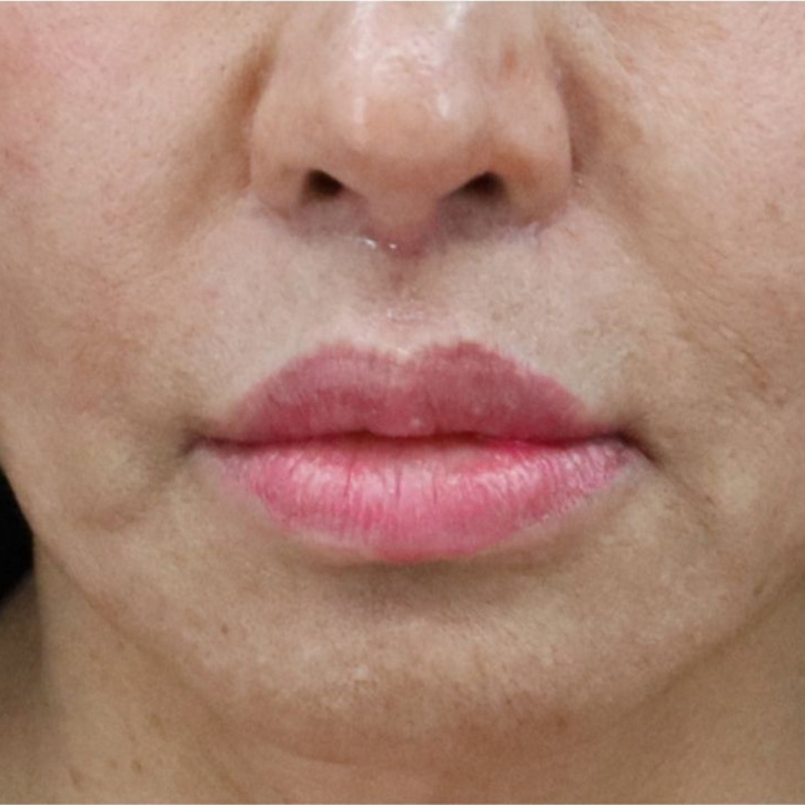 Case--6758 | After Lip Flip