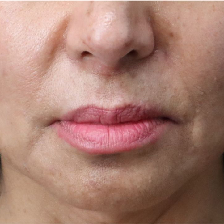 Case--6758 | Before Lip Flip