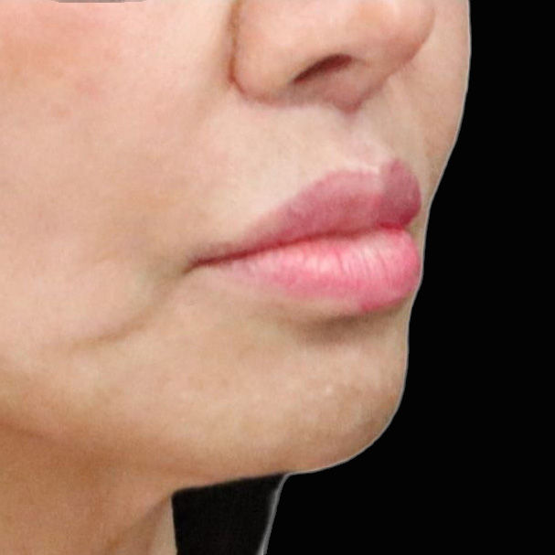 Case--6758 | After Lip Flip 2