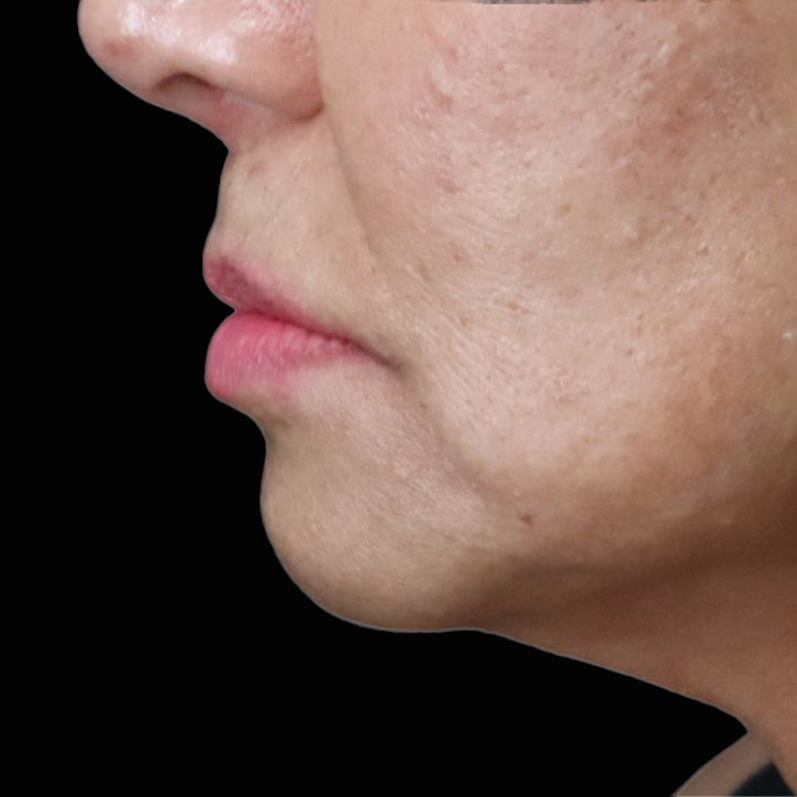 Case--6758 | Before Lip Flip 2